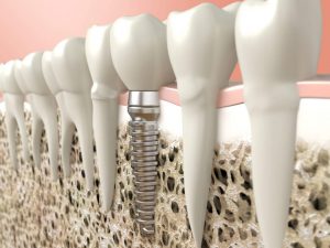 Implante-dentário 