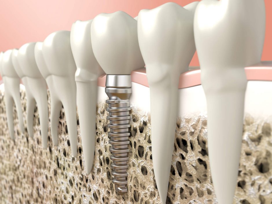 Implante-dentário
