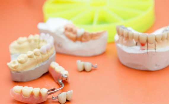 ponte móvel dentária implante