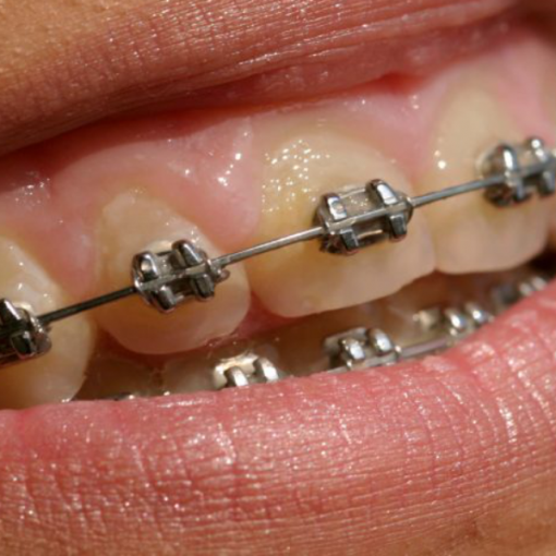 Aparelhos dentários: veja as principais características de cada tipo
