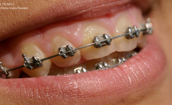 Aparelhos dentários: veja as principais características de cada tipo