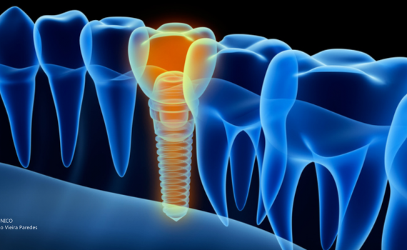 Entenda como deve ser feita a manutenção de dentes implantados