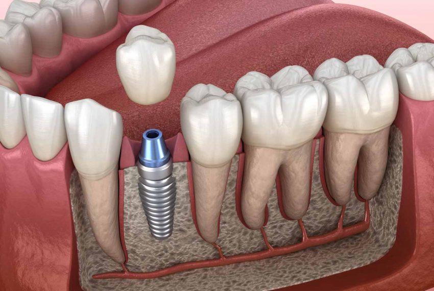 dental-implant-crown-placement.jpg